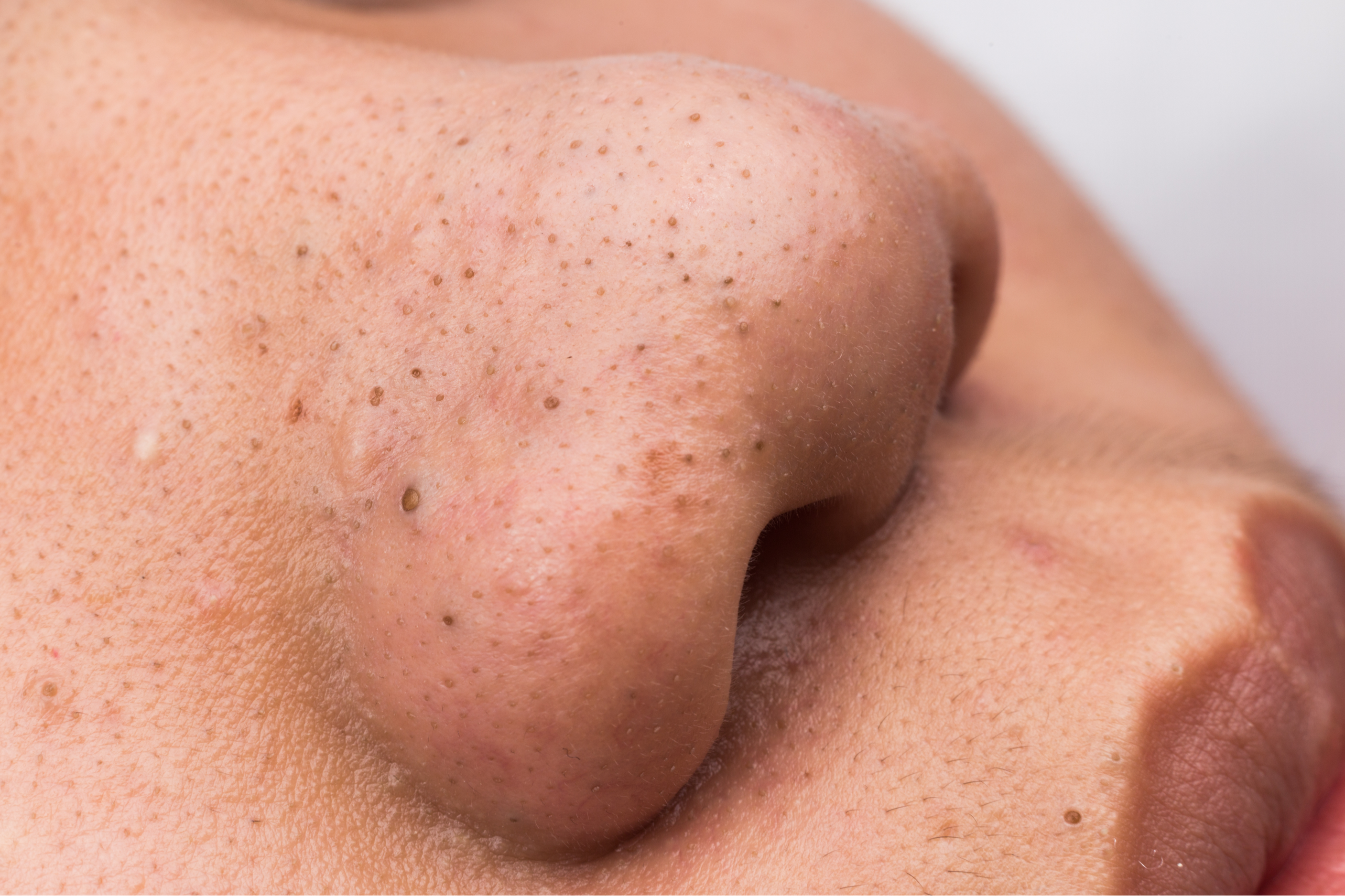 Blackheads Vs Sebaceous Filaments