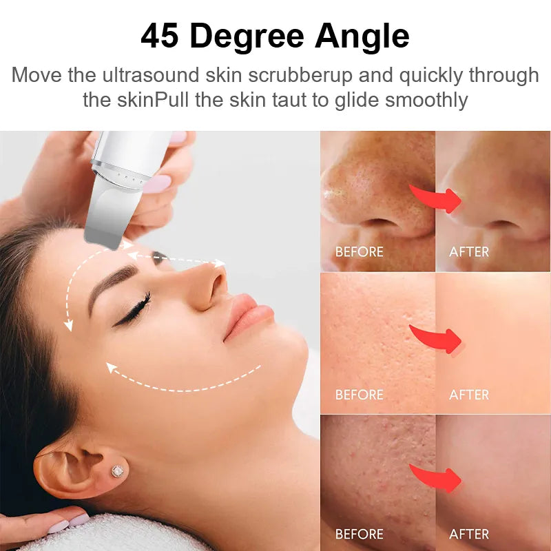 Vibrating Skin Scrubber Face Peeling Blackhead Remover